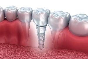 Implants dentaire Levallois